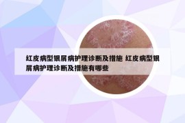 红皮病型银屑病护理诊断及措施 红皮病型银屑病护理诊断及措施有哪些