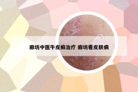 廊坊中医牛皮癣治疗 廊坊看皮肤病