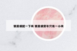银屑病就一下块 银屑病常年只有一小块