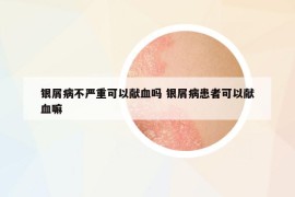 银屑病不严重可以献血吗 银屑病患者可以献血嘛