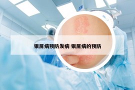 银屑病预防发病 银屑病的预防