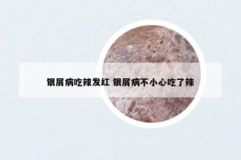 银屑病吃辣发红 银屑病不小心吃了辣