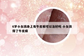 6岁小女孩身上有牛皮癣可以治好吗 小女孩得了牛皮癣