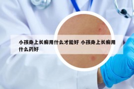 小孩身上长癣用什么才能好 小孩身上长癣用什么药好