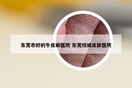 东莞市好的牛皮癣医院 东莞权威皮肤医院