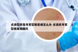 点滴型转变寻常型银屑病怎么办 点滴状寻常型银屑病图片