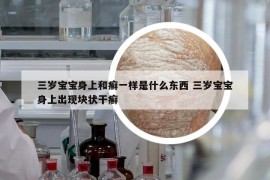三岁宝宝身上和癣一样是什么东西 三岁宝宝身上出现块状干癣