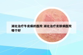 湖北治疗牛皮癣的医院 湖北治疗皮肤病医院哪个好