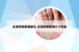 点滴型银屑病部位 点滴型银屑病三个阶段