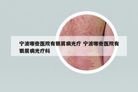 宁波哪些医院有银屑病光疗 宁波哪些医院有银屑病光疗科