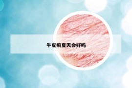 牛皮癣夏天会好吗