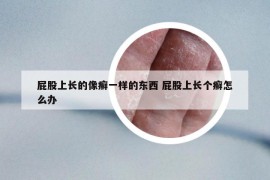 屁股上长的像癣一样的东西 屁股上长个癣怎么办