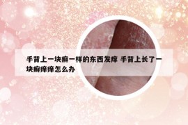手背上一块癣一样的东西发痒 手背上长了一块癣痒痒怎么办