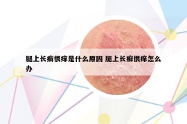 腿上长癣很痒是什么原因 腿上长癣很痒怎么办