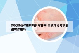 净化血液对银屑病有啥作用 血液净化对银屑病有作用吗