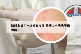 胳膊上长了一块癣有皮屑 胳膊上一块块干燥像癣