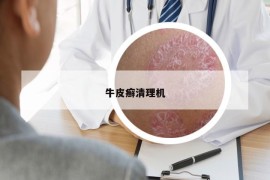牛皮癣清理机