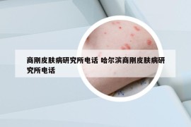 商刚皮肤病研究所电话 哈尔滨商刚皮肤病研究所电话