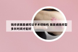钱币状银屑病可以手术切除吗 银屑病钱币型多长时间才能好