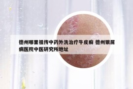 德州哪里祖传中药外洗治疗牛皮癣 德州银屑病医院中医研究所地址