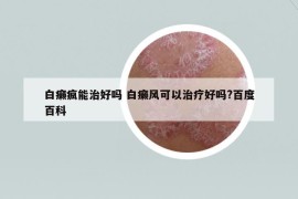 白癞疯能治好吗 白癞风可以治疗好吗?百度百科