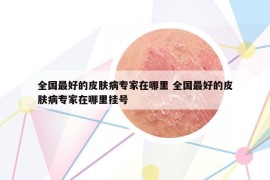全国最好的皮肤病专家在哪里 全国最好的皮肤病专家在哪里挂号