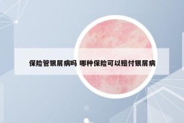 保险管银屑病吗 哪种保险可以赔付银屑病