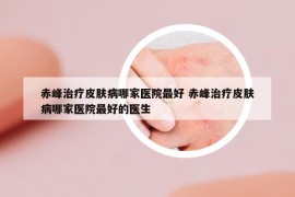 赤峰治疗皮肤病哪家医院最好 赤峰治疗皮肤病哪家医院最好的医生