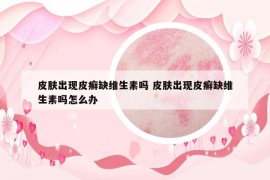 皮肤出现皮癣缺维生素吗 皮肤出现皮癣缺维生素吗怎么办