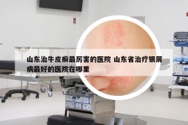 山东治牛皮癣最厉害的医院 山东省治疗银屑病最好的医院在哪里