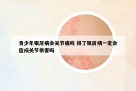 青少年银屑病会关节痛吗 得了银屑病一定会造成关节损害吗
