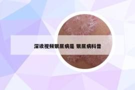 深读视频银屑病是 银屑病科普
