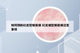 如何预防红皮型银屑病 红皮病型银屑病注意事项