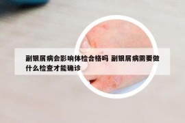 副银屑病会影响体检合格吗 副银屑病需要做什么检查才能确诊