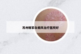 苏州哪家白癜风治疗医院好