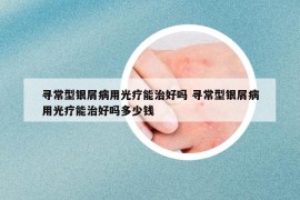 寻常型银屑病用光疗能治好吗 寻常型银屑病用光疗能治好吗多少钱