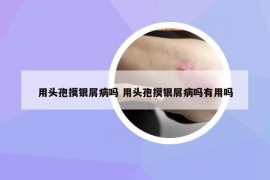 用头孢摸银屑病吗 用头孢摸银屑病吗有用吗