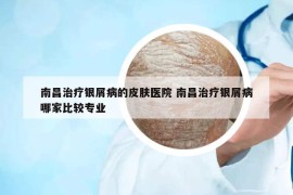 南昌治疗银屑病的皮肤医院 南昌治疗银屑病哪家比较专业