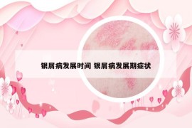 银屑病发展时间 银屑病发展期症状
