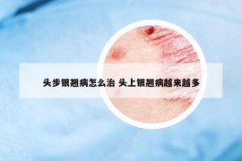 头步银翘病怎么治 头上银翘病越来越多