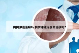 构树津液治癣吗 构树津液治皮炎湿疹吗?