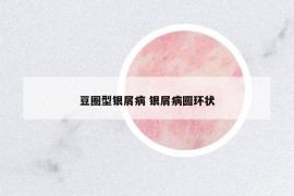 豆圈型银屑病 银屑病圆环状