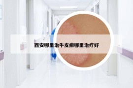 西安哪里治牛皮癣哪里治疗好