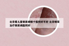 北京看儿童银屑病哪个医院好不好 北京哪家治疗银屑病医院好