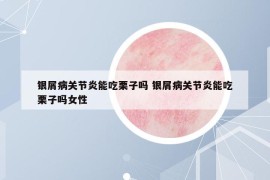 银屑病关节炎能吃栗子吗 银屑病关节炎能吃栗子吗女性