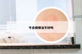 牛皮癣根治不好吗