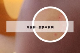 牛皮癣一般多大发病