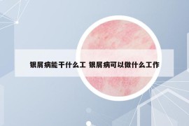 银屑病能干什么工 银屑病可以做什么工作