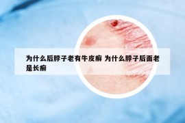 为什么后脖子老有牛皮癣 为什么脖子后面老是长癣