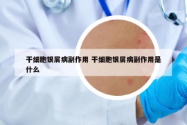 干细胞银屑病副作用 干细胞银屑病副作用是什么